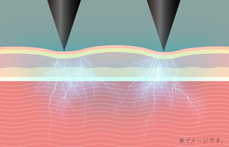 深部刺激 イメージ